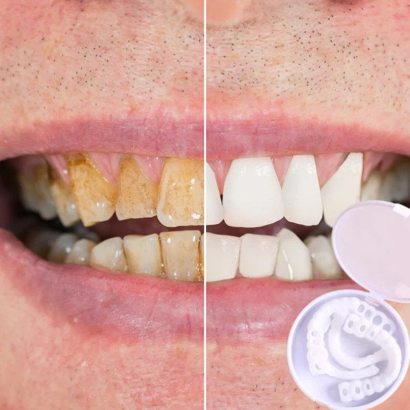 Flexible snap-on cosmetic tooth covers - product photo 2